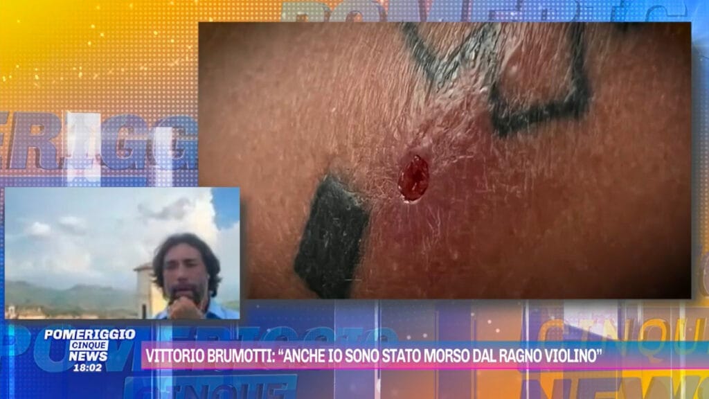 Che paura per Vittorio Brumotti, morso 2 volte da un ragno violino: «Ho avuto la febbre a 41.7». Ma il biker l'ha presa con ironia: «il ragno ha avuto la sfortuna di mordere me e si prenderà il mio virus» vittorio brumotti ragno violino