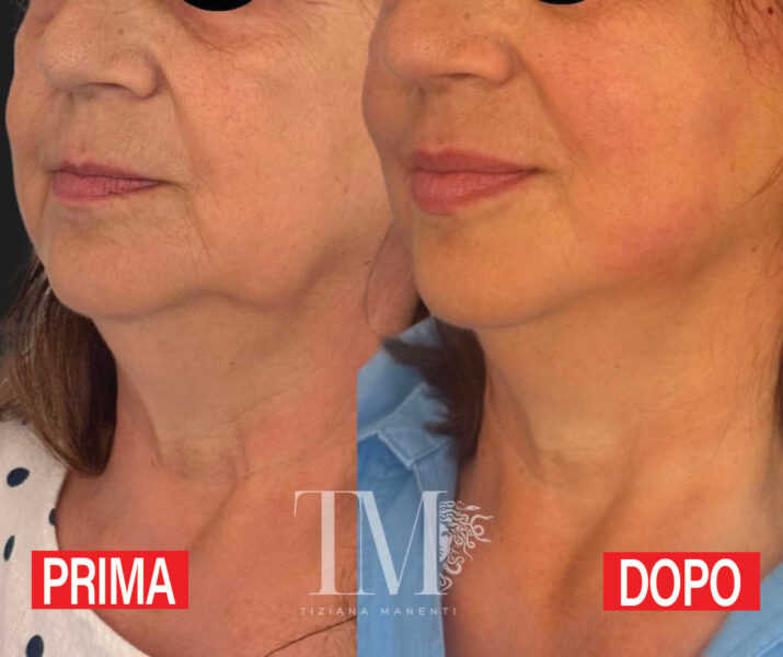 Il lifting della pausa pranzo: il segreto di un viso fresco e naturale, senza stravolgimenti e senza tempi di recupero lunghi - A cura della dottoressa Tiziana Manenti Tiziana Manenti lifting della pausa pranzo
